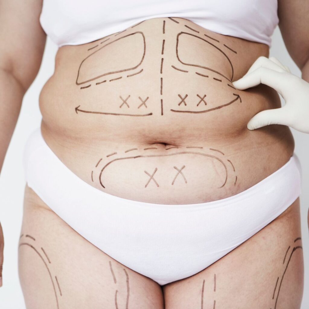 Abdominoplastía Abdominoplastía