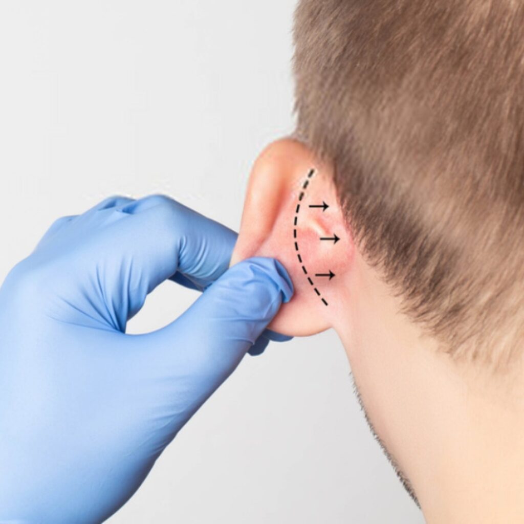 Otoplastía