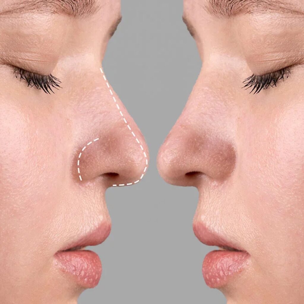 RINOPLASTIA