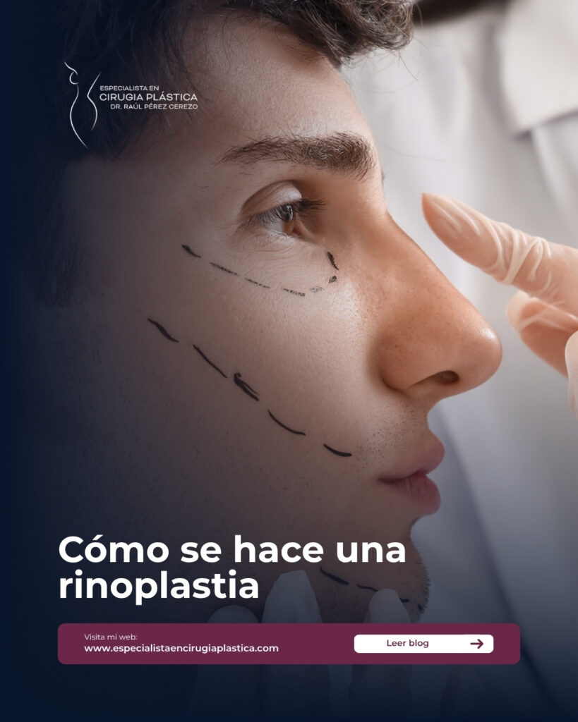 Cómo se hace una rinoplastia Cómo se hace una rinoplastia