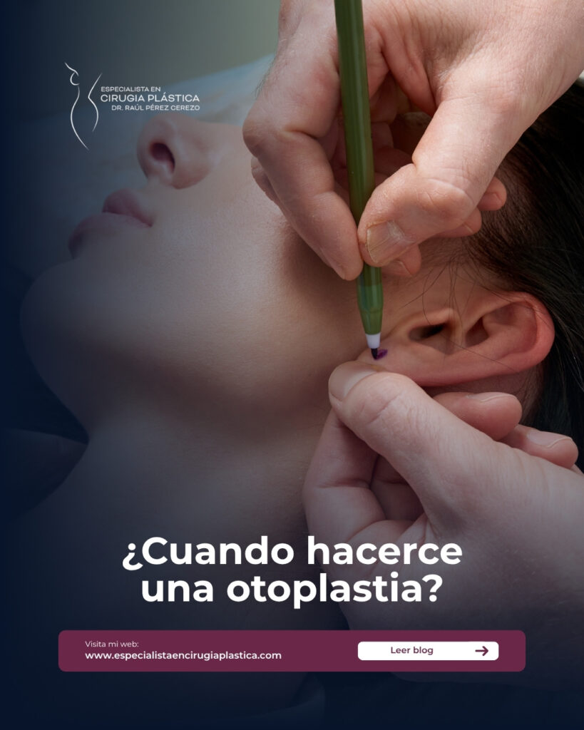 Cuando hacerce una otoplastia Cuando hacerce una otoplastia