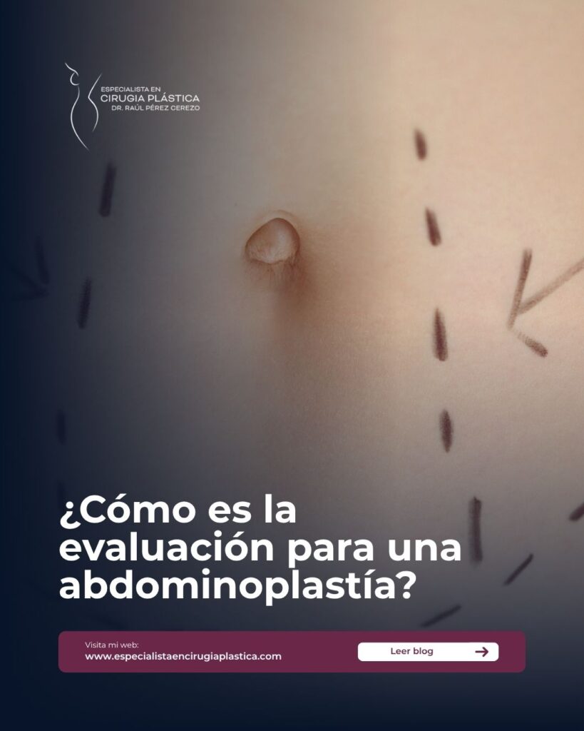 Cuándo hacerse una abdominoplastia Cuándo hacerse una abdominoplastia