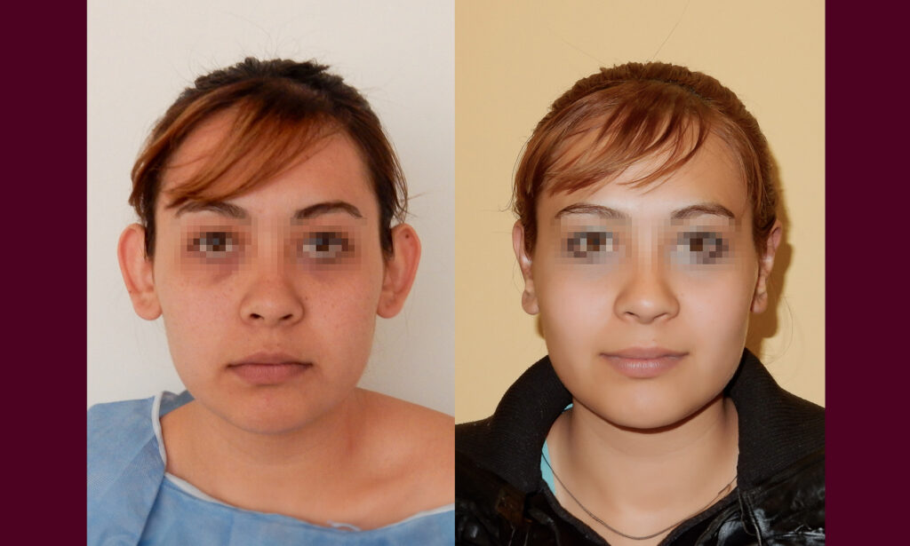 Otoplastia en CDMX 