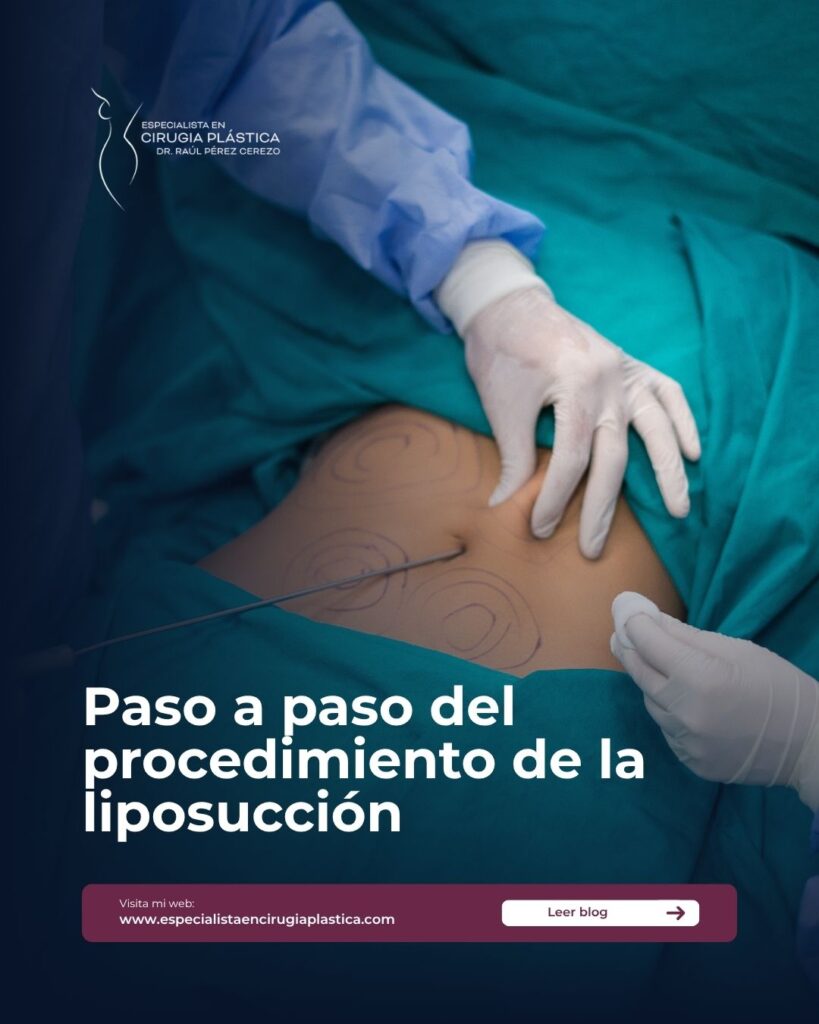 liposucción liposucción