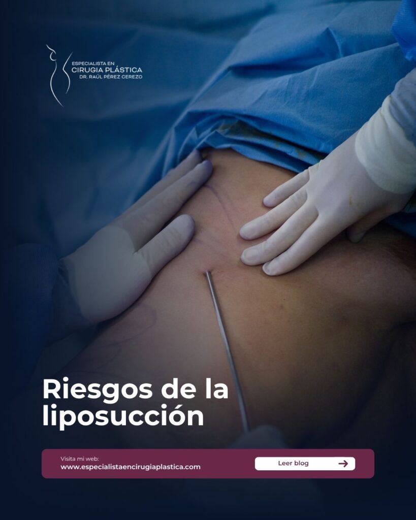 Riesgos de la liposucción Riesgos de la liposucción