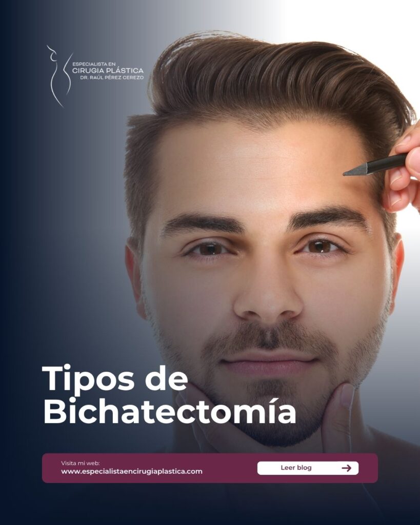 Tipos de Bichatectomía Tipos de Bichatectomía