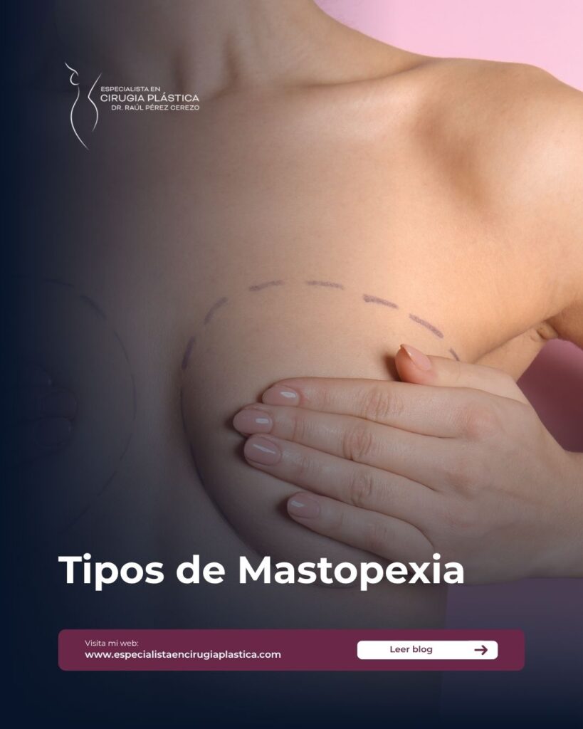 Tipos de Mastopexia Tipos de Mastopexia