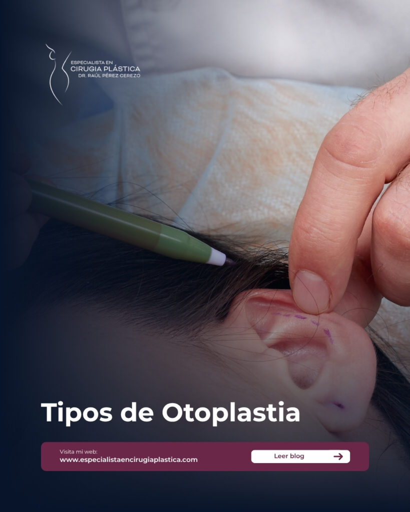 Tipos de Otoplastia Tipos de Otoplastia