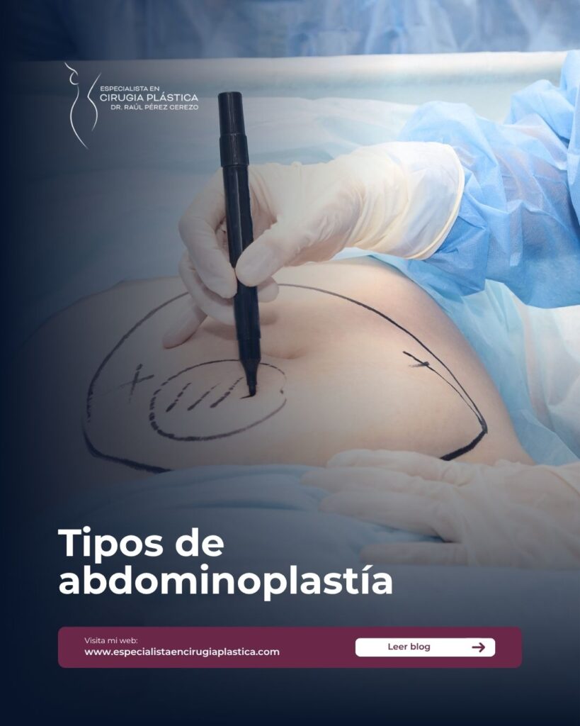 Tipos de abdominoplastía Tipos de abdominoplastía