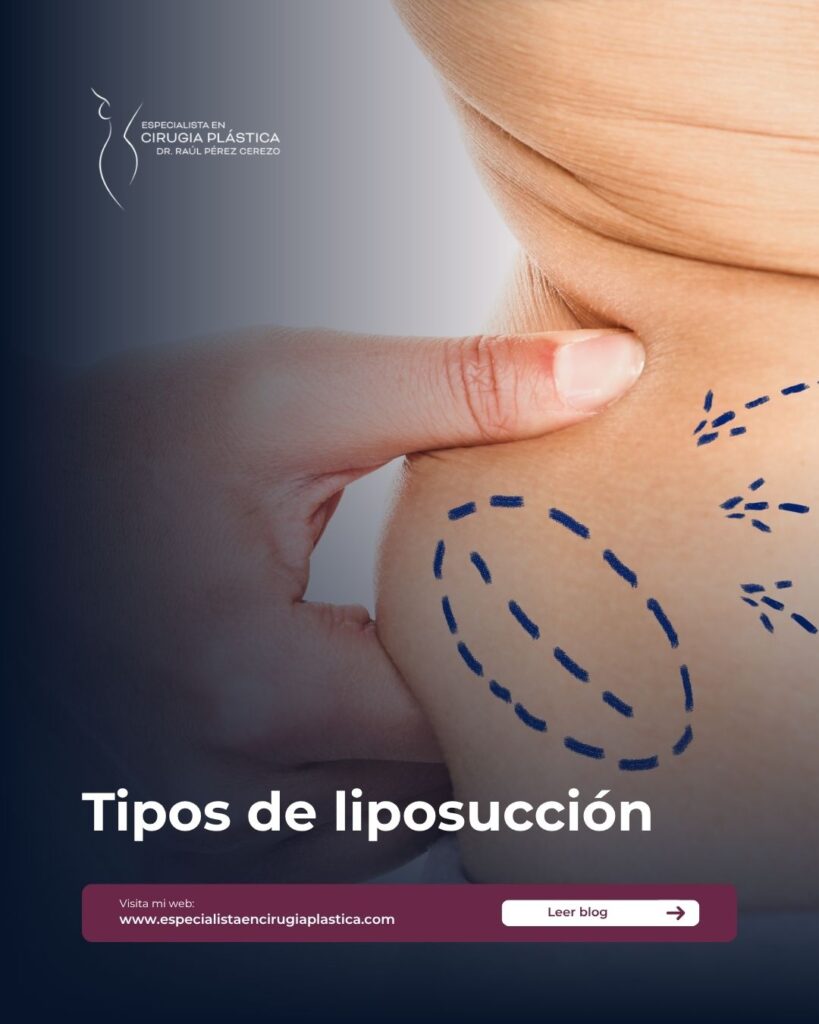 Tipos de liposucción Tipos de liposucción