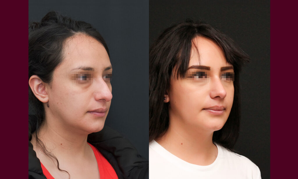 Rinoplastia en CDMX