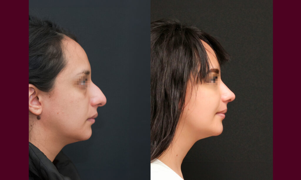 Rinoplastia en CDMX