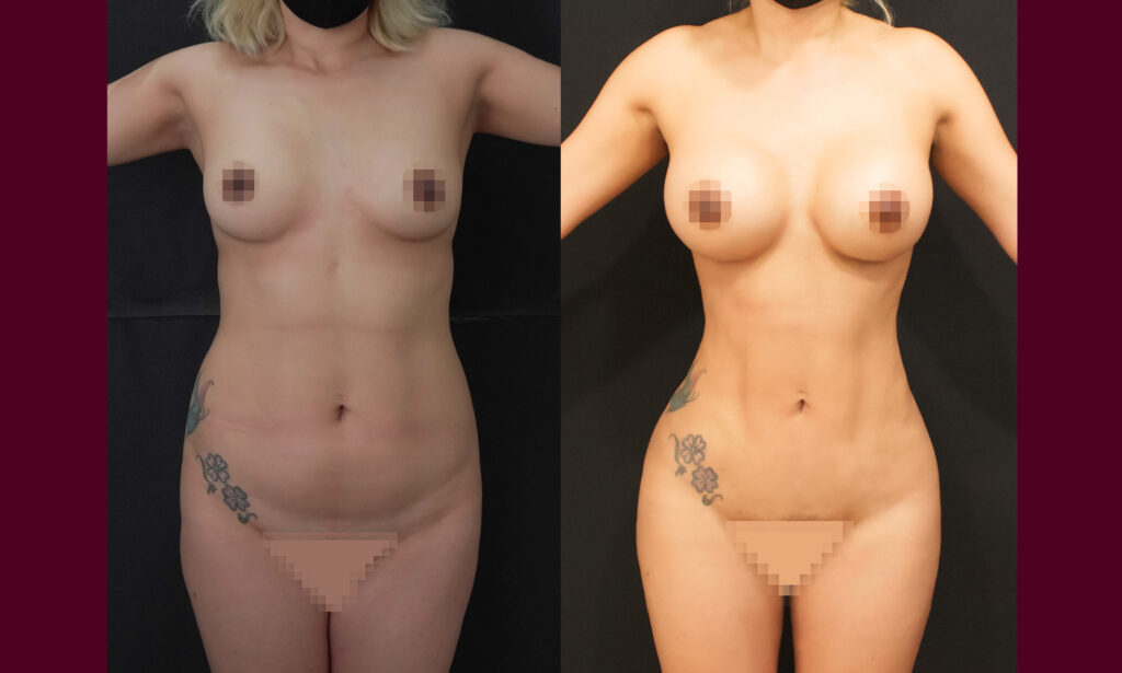 lipo5v1.jpg Cirujano Plástico Certificado